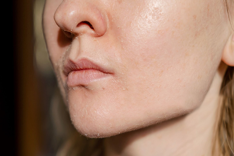 زبر و خشن شدن پوست